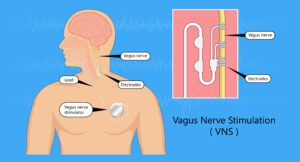 An image of a Vagus Nerve Stimulation device used for vagal toning for anxiety therapy